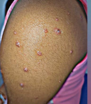 ImagenDesmiente gobierno casos de Mpox en Campeche