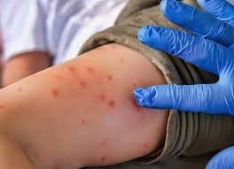 Confirman muerte de niño de 8 años por sarampión en Durango