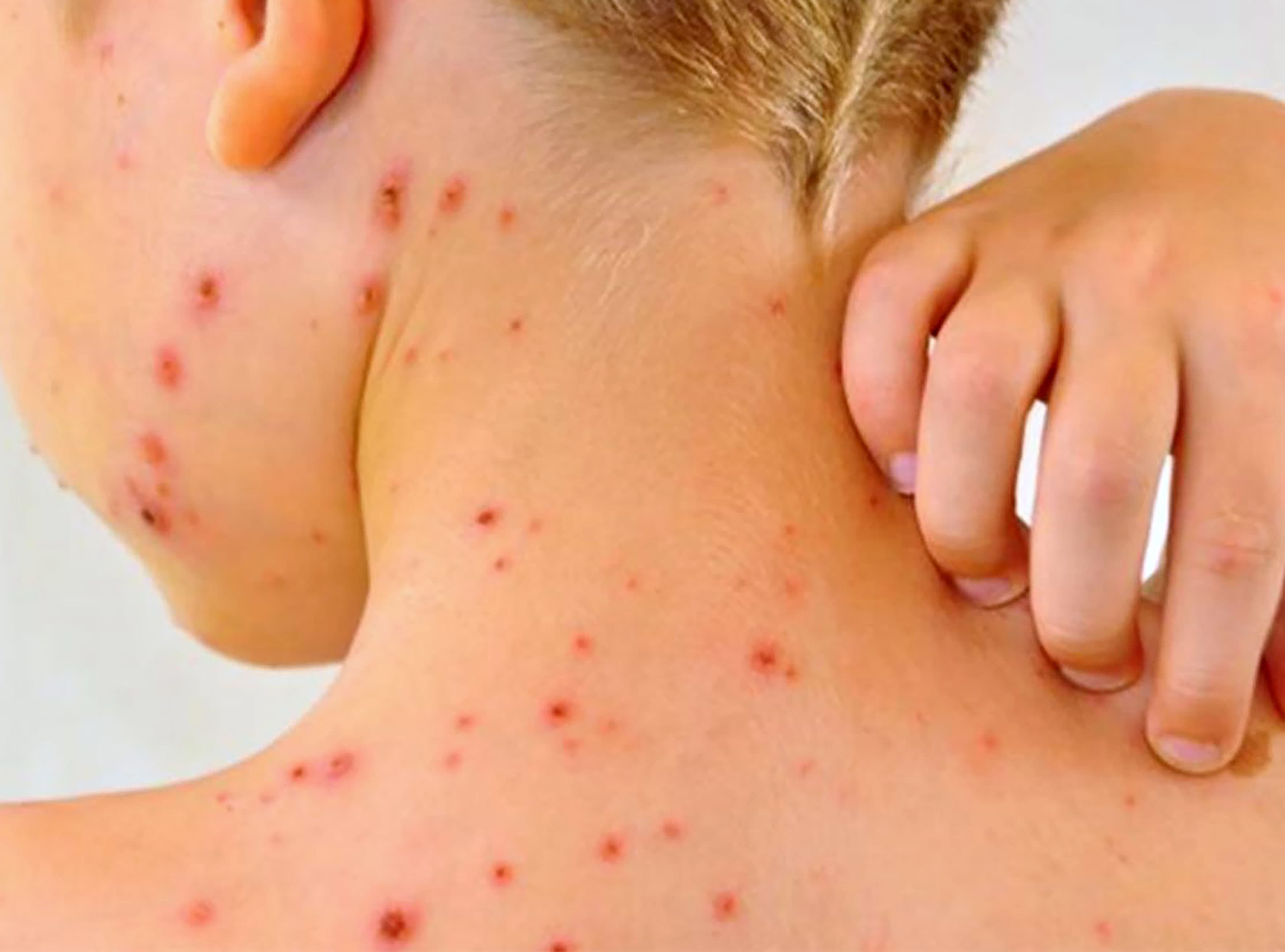 Registra Chiapas primera muerte por Sarampión