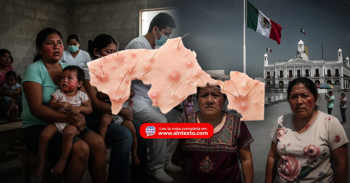 Acumula Tabasco 50 casos de Sarampión