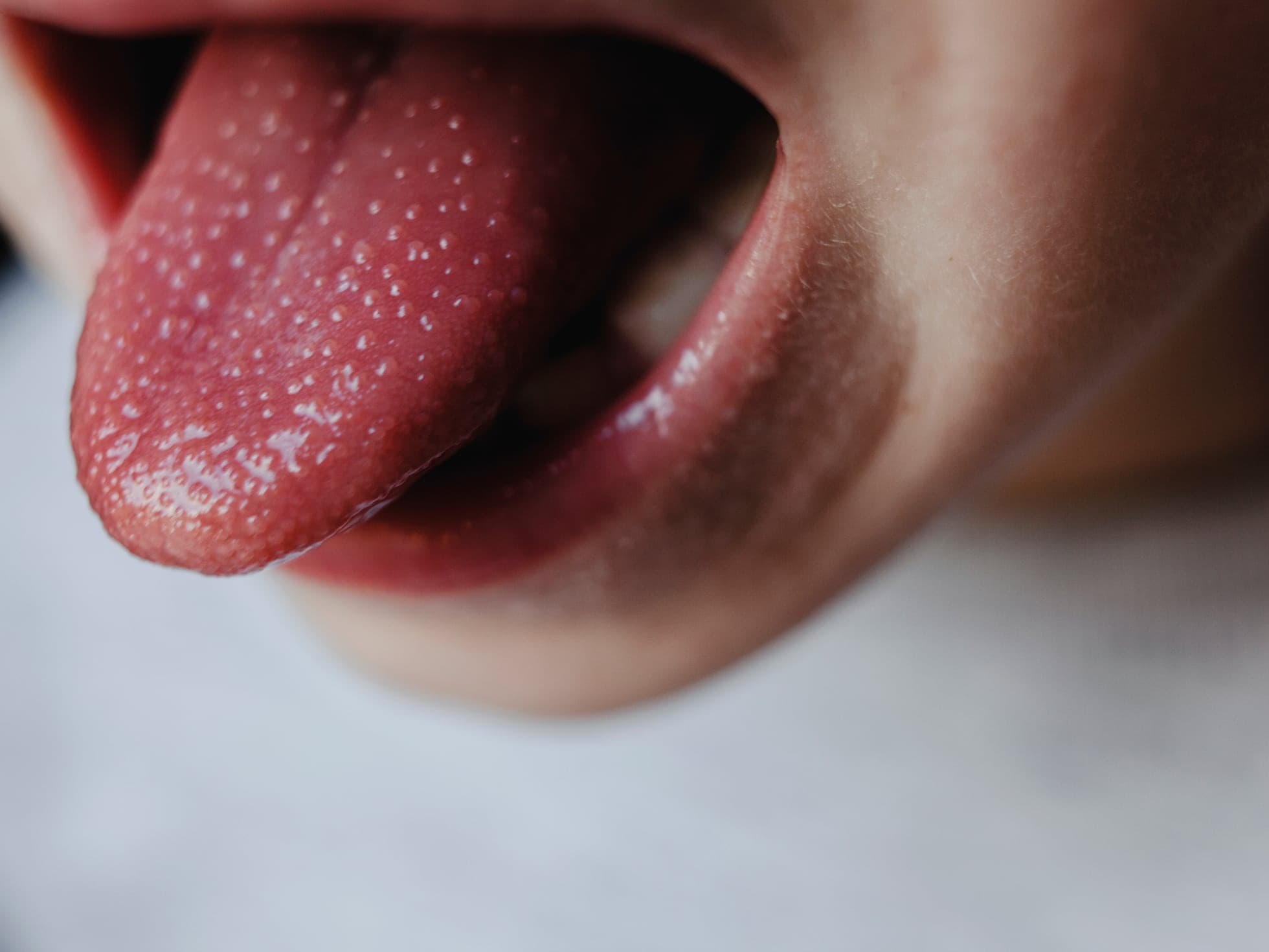 Casos de fiebre escarlatina en México rebasan cifras de 2023